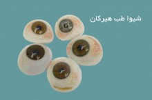چشم مصنوعی در بوشهر