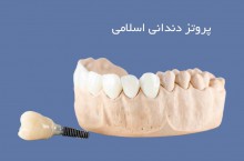 پروتز دندانی اسلامی